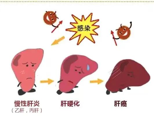 绿巨人污APP厂家提醒肝脏疾病治不好？要了解是否含铁食物摄入多